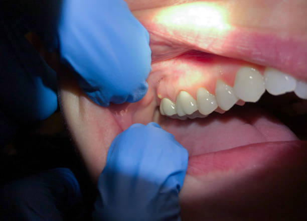 Best Emergency Tooth Extraction in Orland Hls, IL